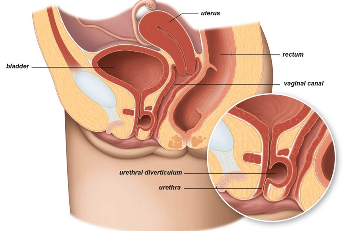 Urethral Diverticulum