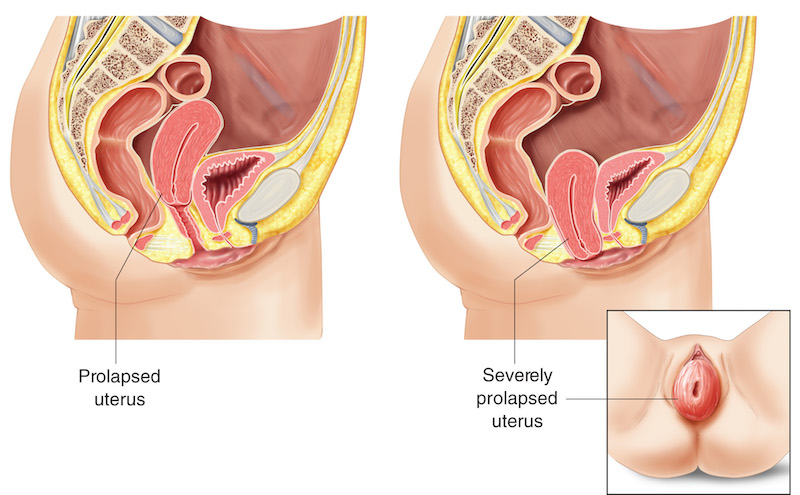 Uterine Prolapse