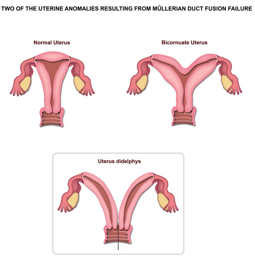 Uterus Didelphys