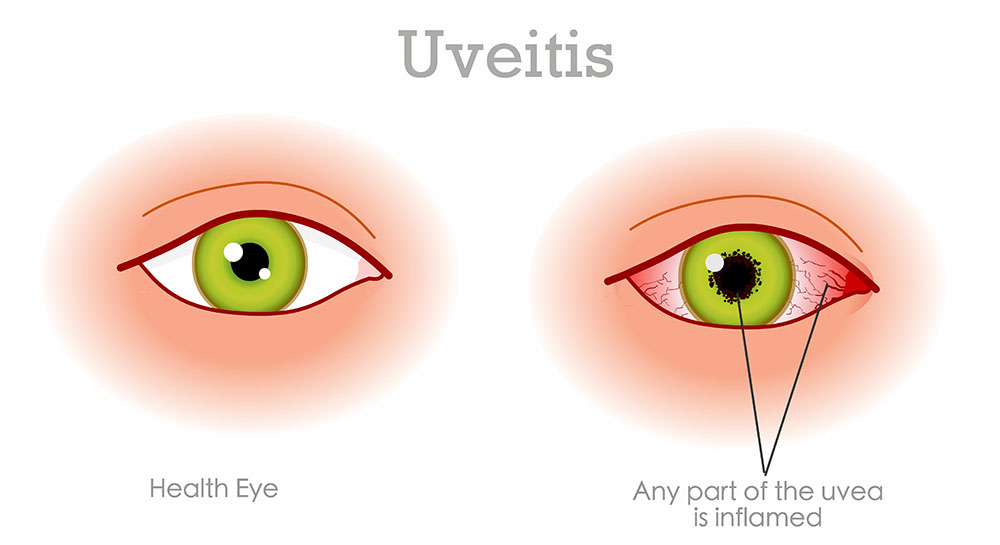 Uveitis