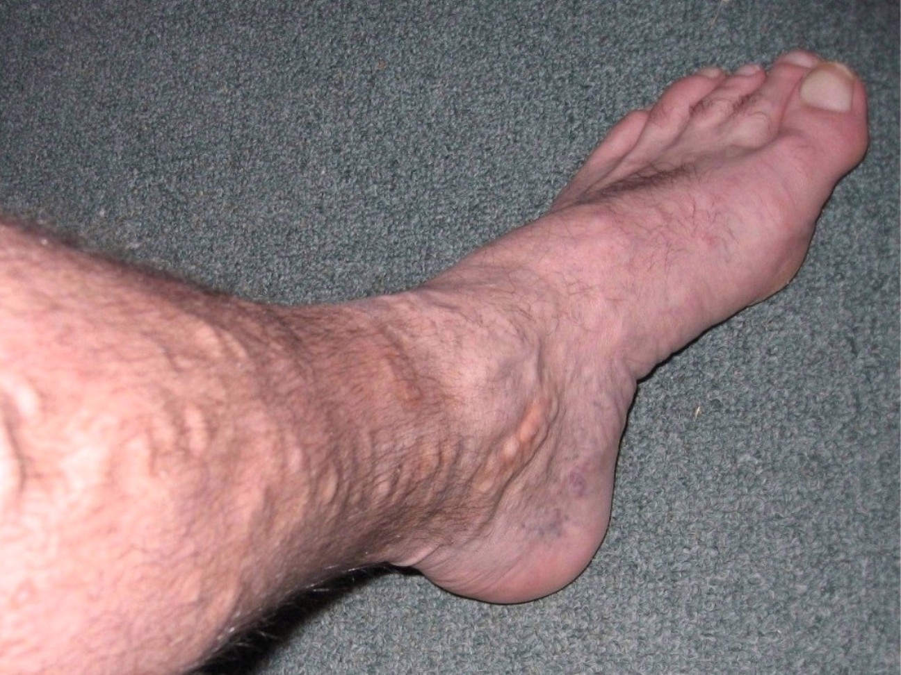 Varicose Veins