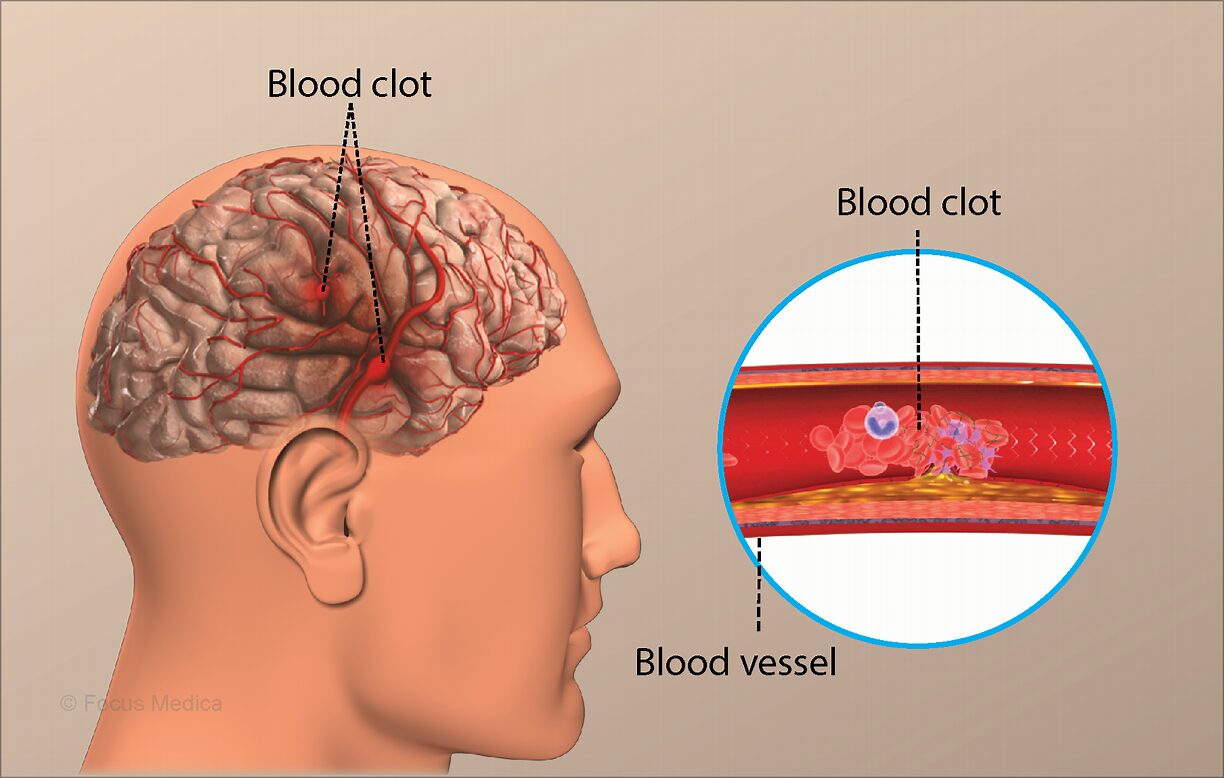 Vascular Dementia