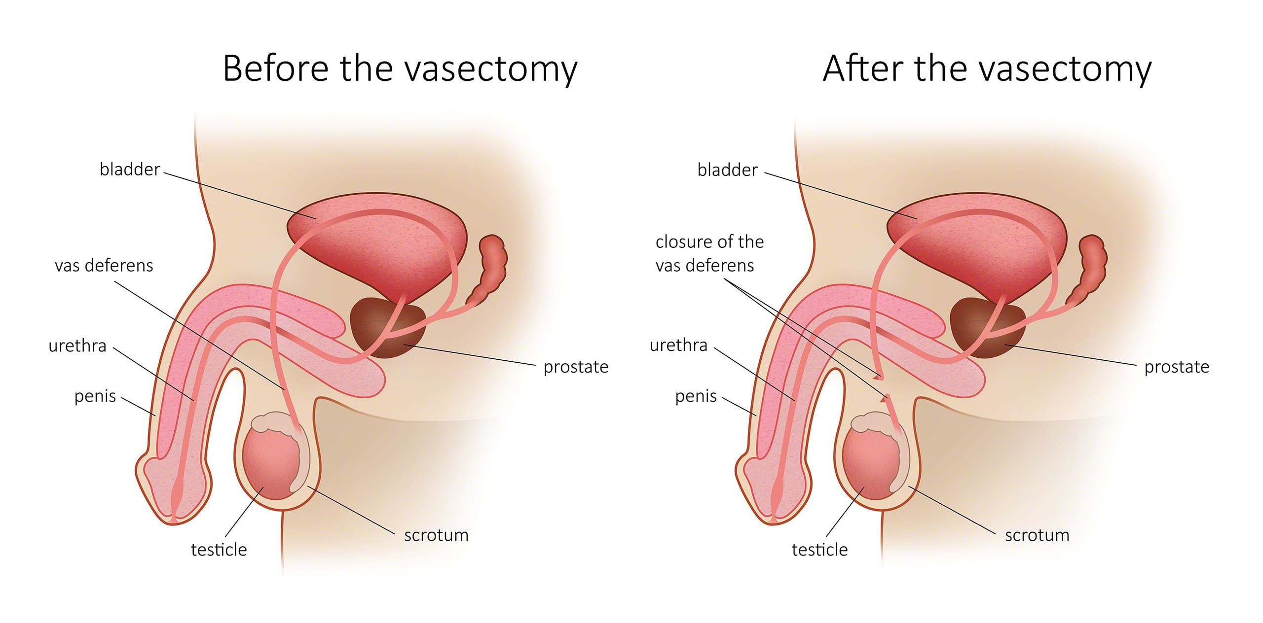 Vasectomy