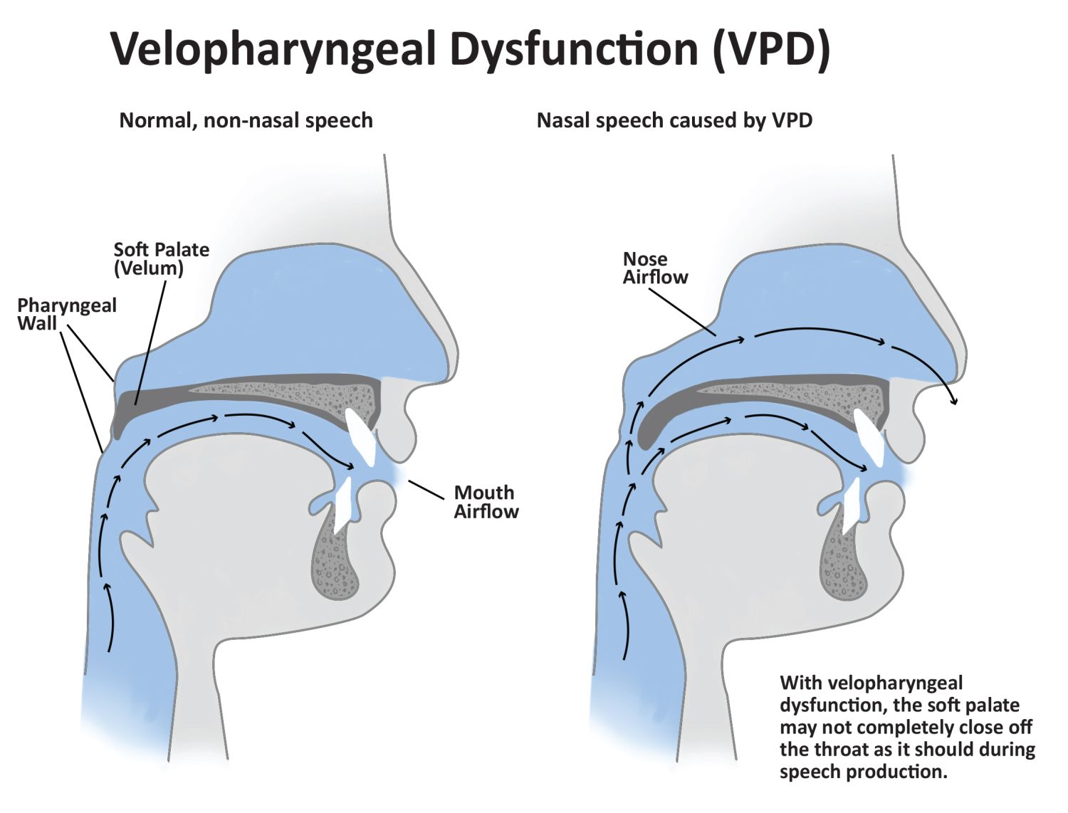 Velopharyngeal Insufficiency