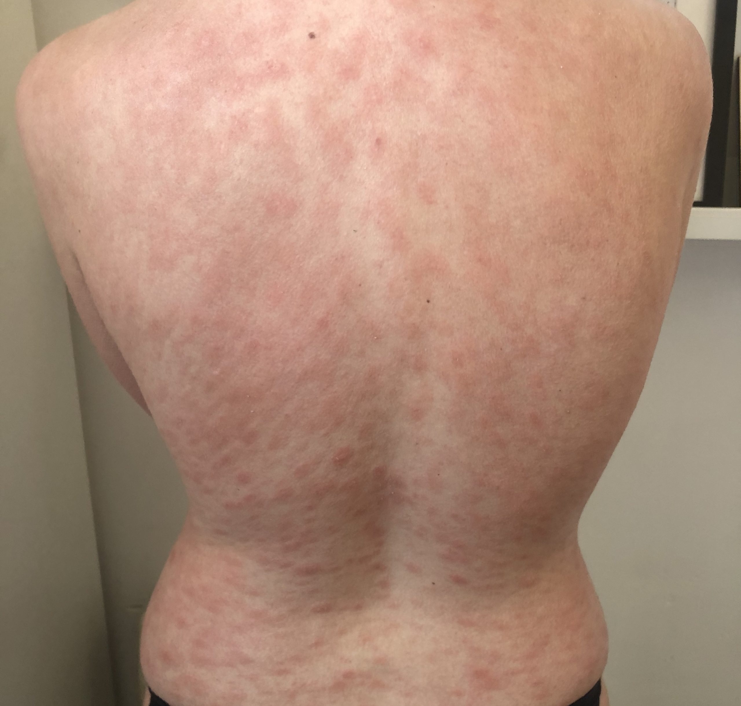 Viral Exanthem Rash