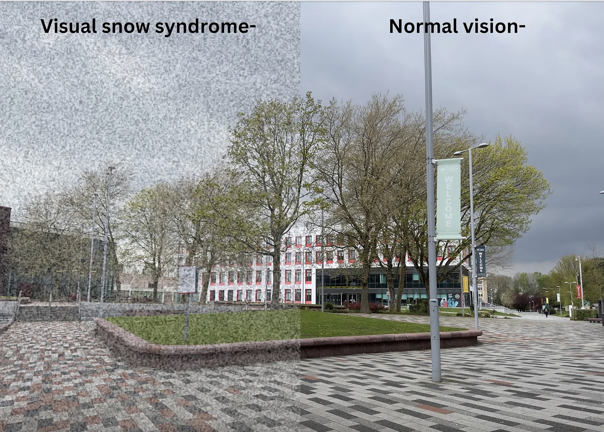 Visual Snow Syndrome