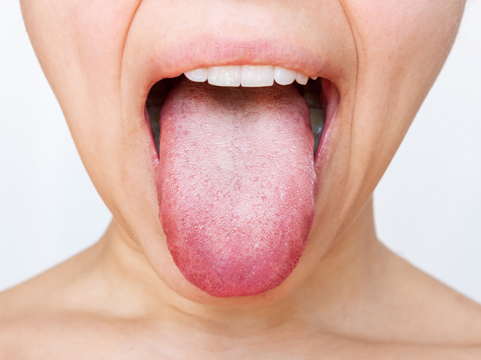 White Tongue: Symptoms, Causes, Treatment