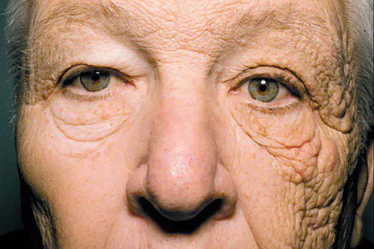 Wrinkles: Symptoms, Causes, Treatment