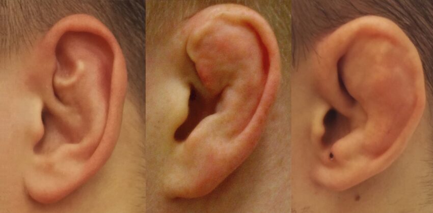 cauliflower ear