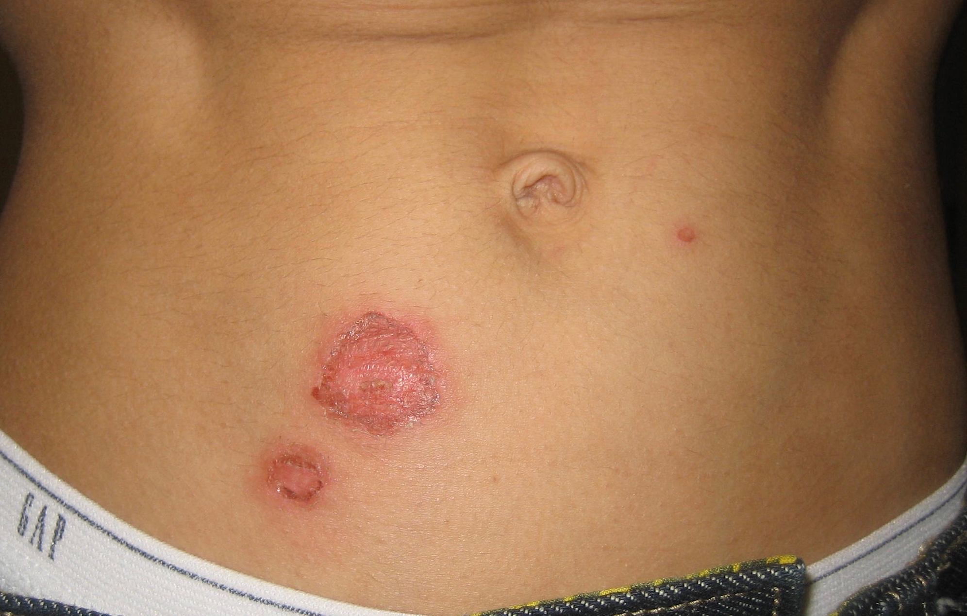 impetigo