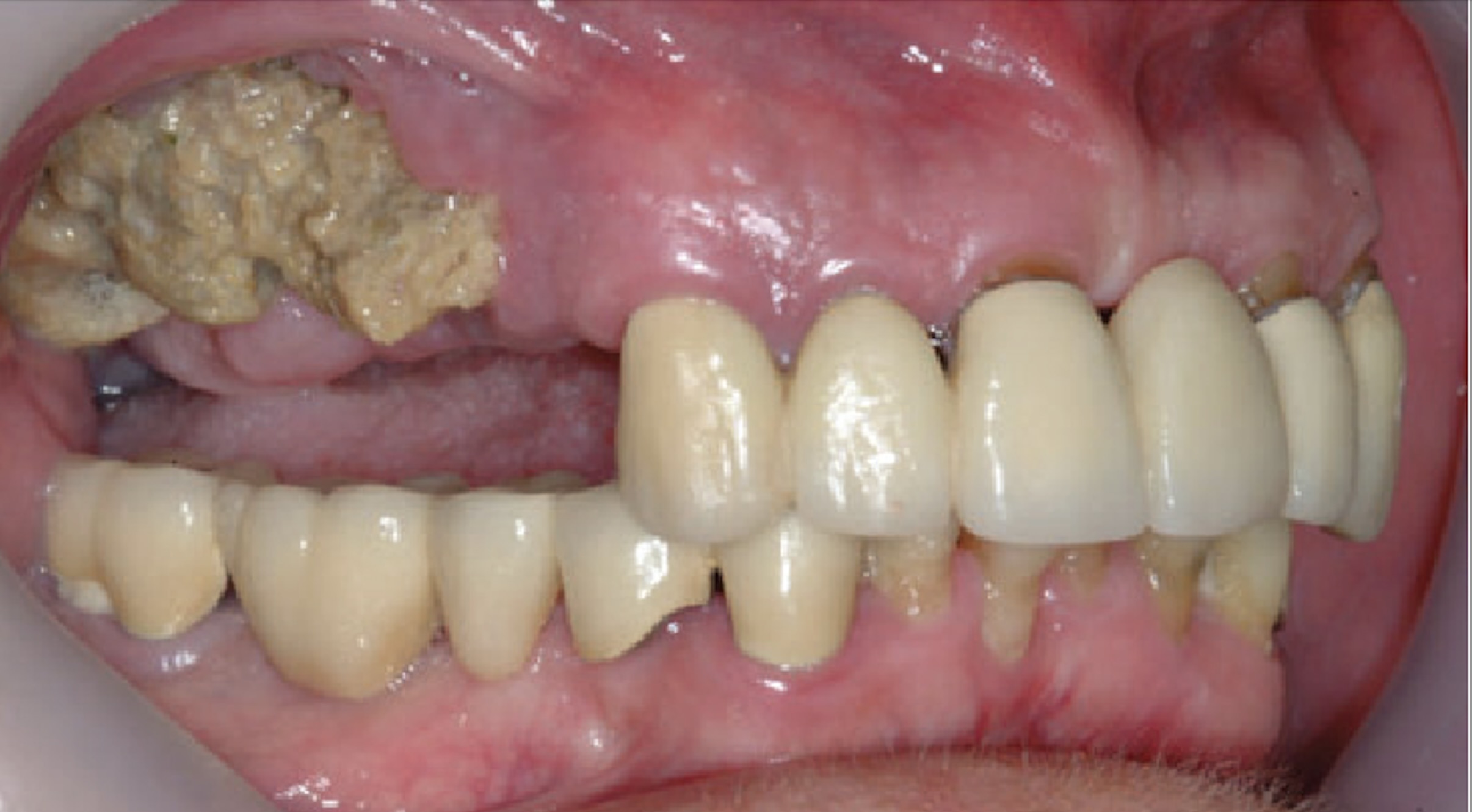 osteonecrosis of the jaw