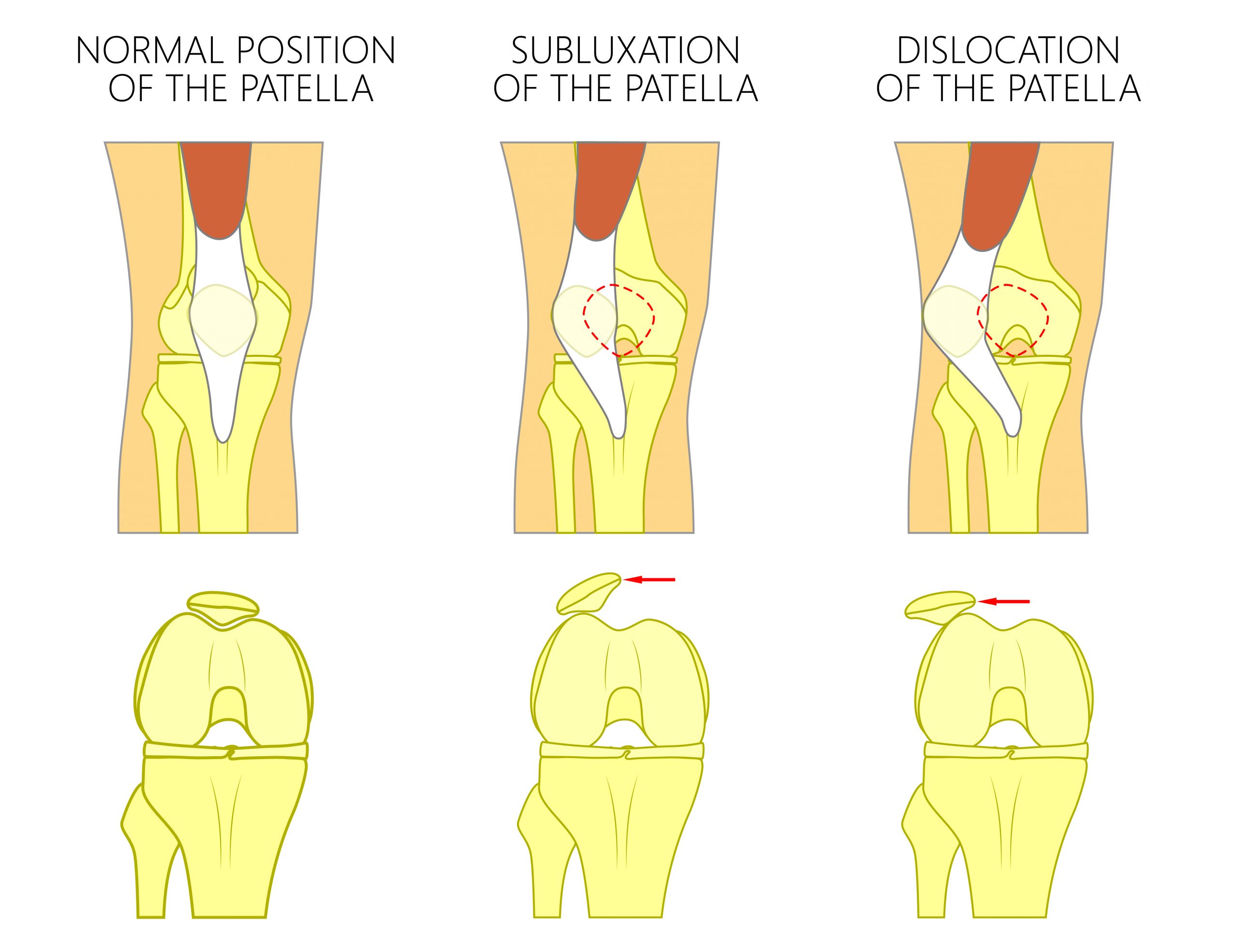 patellar dislocation