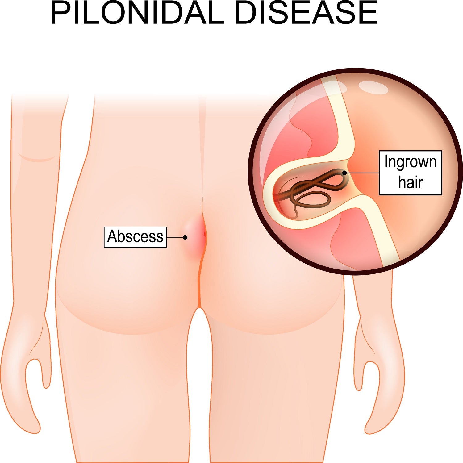 pilonidal cysts