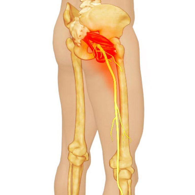 piriformis syndrome