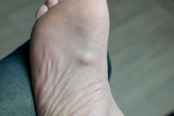 plantar fibroma