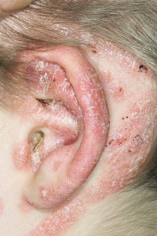 psoriasis in the ears