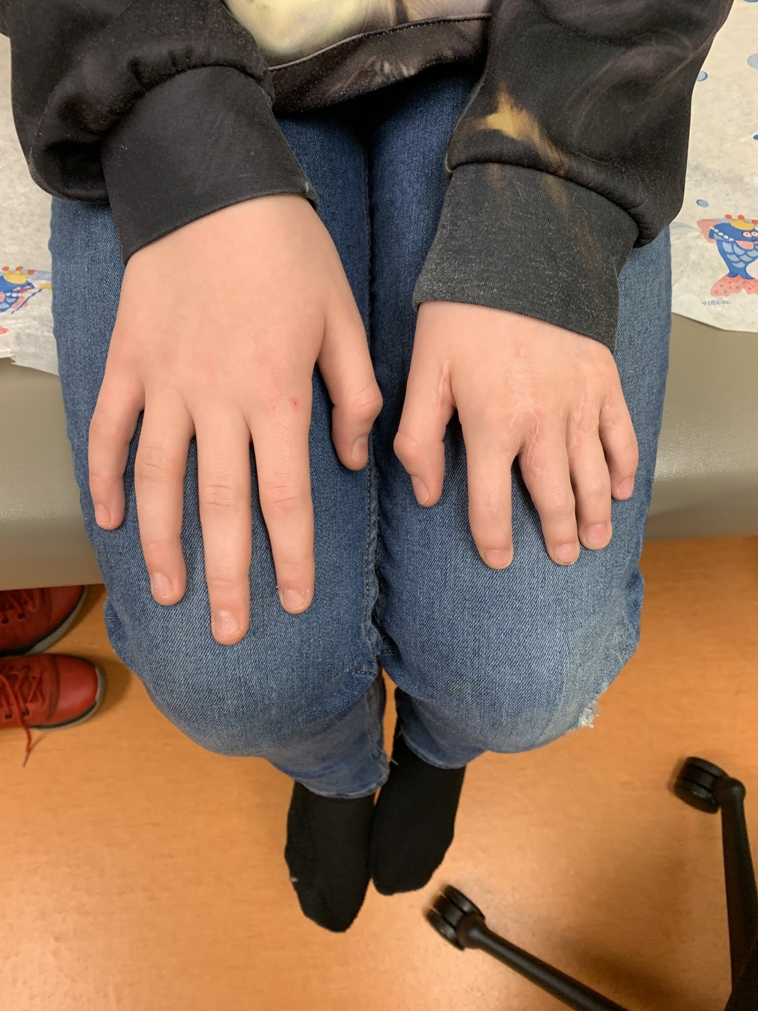 short fingers