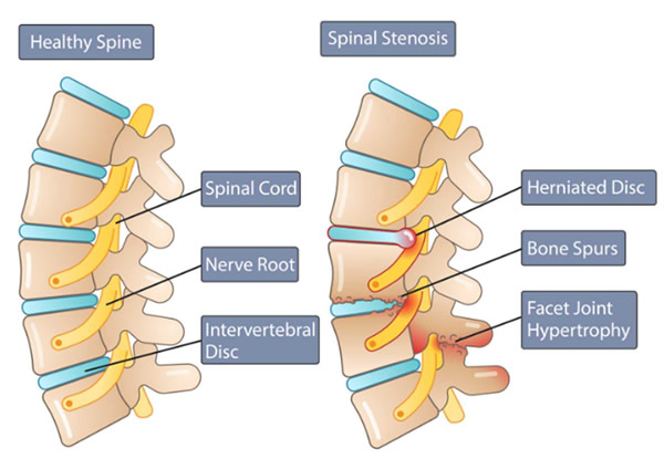 spinal stenosis