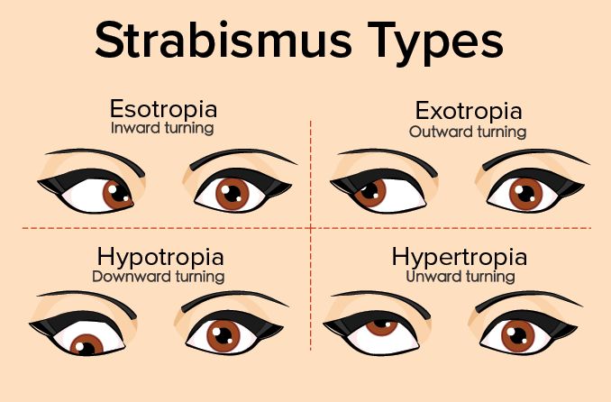 strabismus