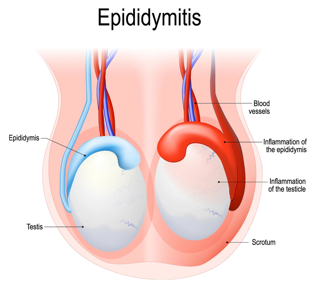 testicular pain