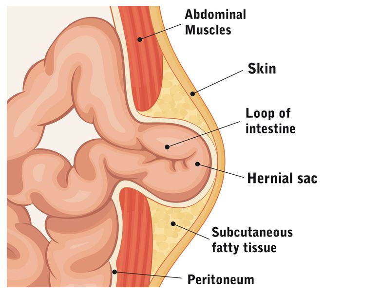 umbilical hernia