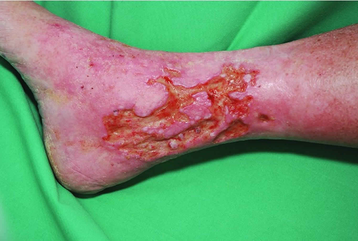 Venous Ulcer: Symptoms, Causes, Treatment