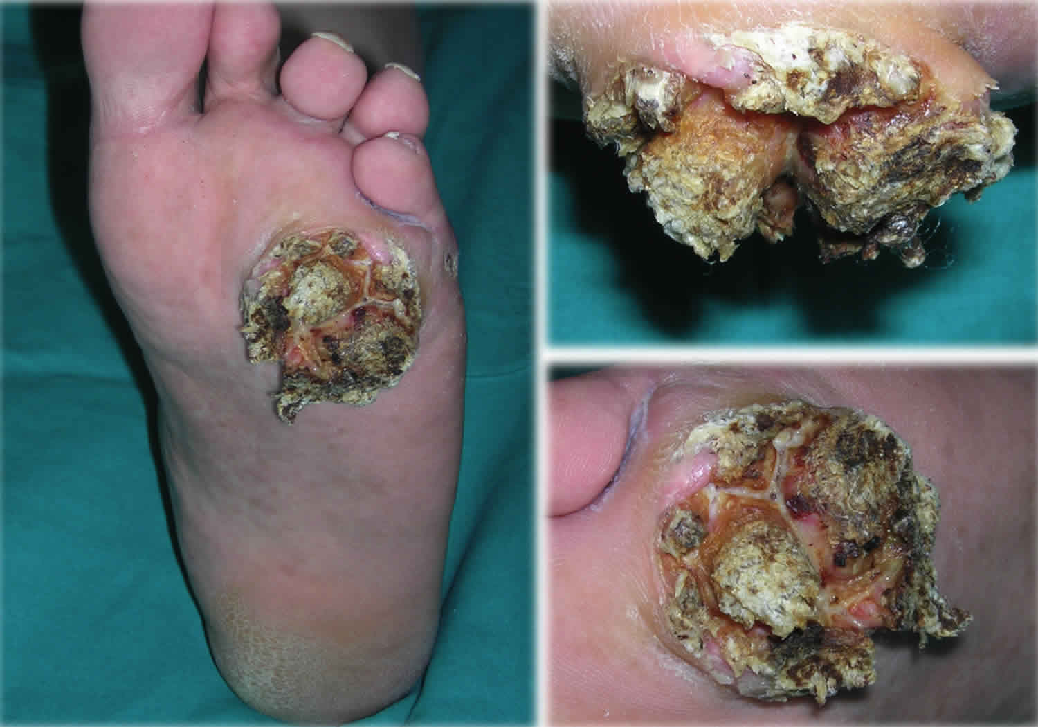 Verrucous Carcinoma: Symptoms, Causes, Treatment