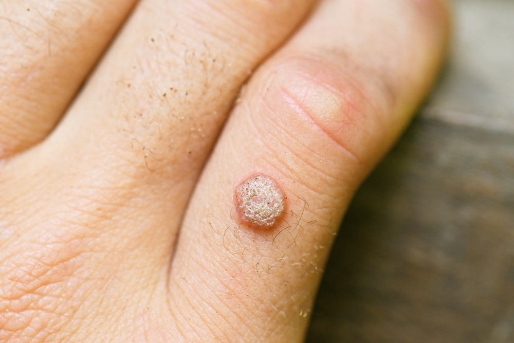 Warts: Symptoms, Causes, Treatment