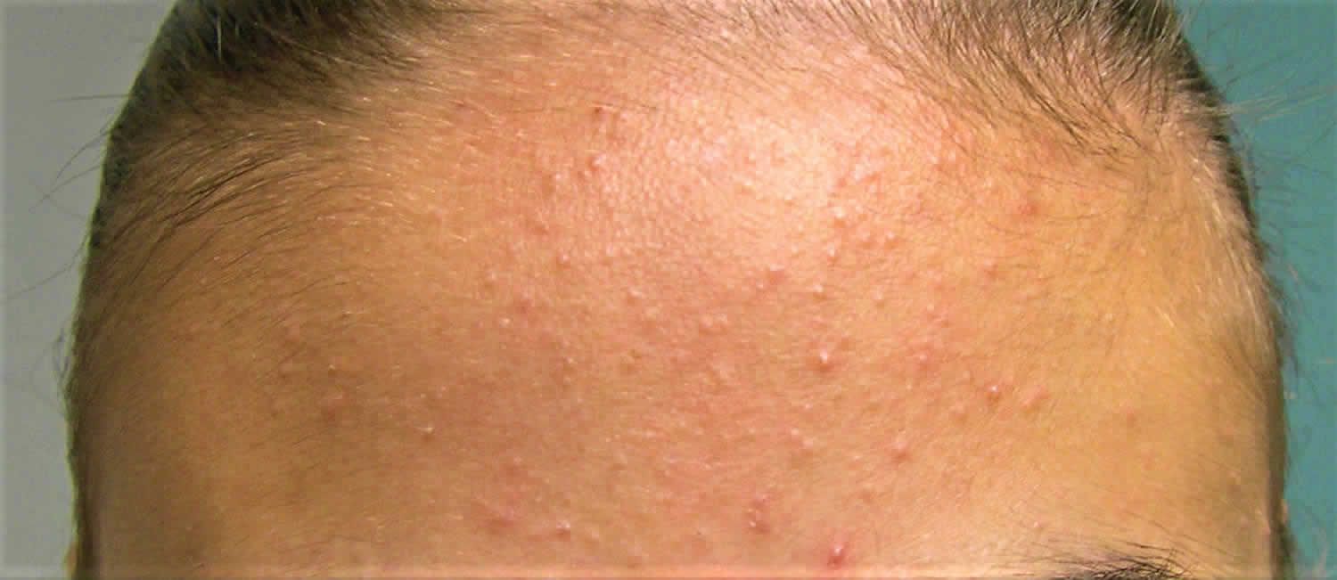 Whiteheads: Symptoms, Causes, Treatment